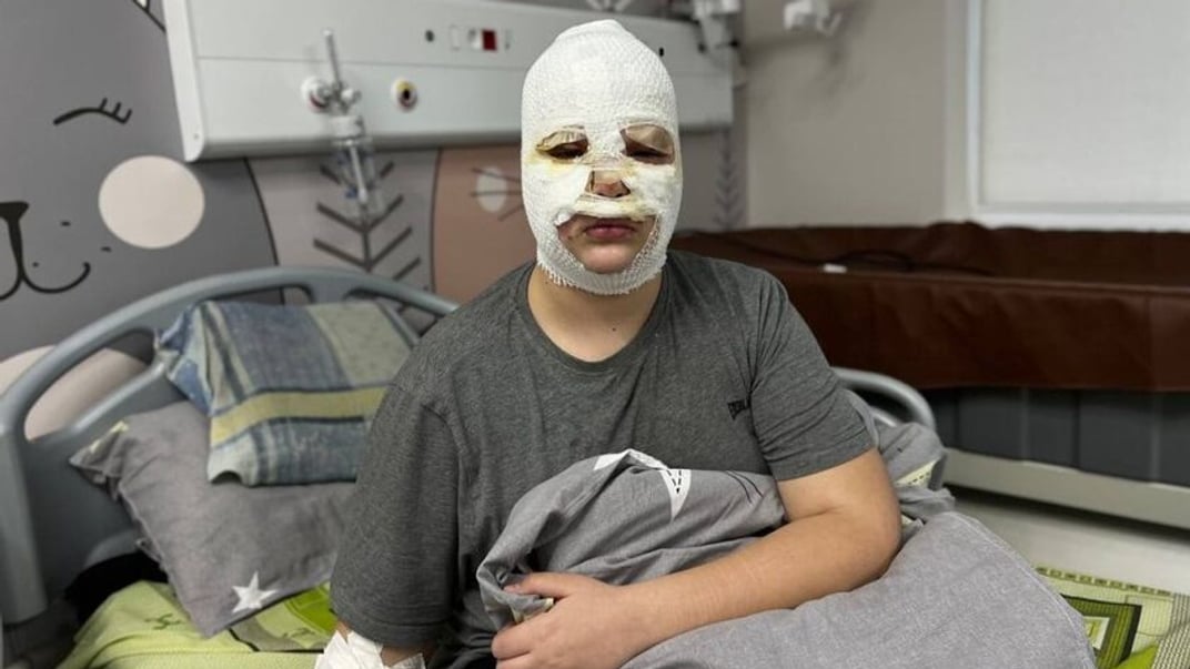 Хлопчик, який постраждав через саморобну вибухівку