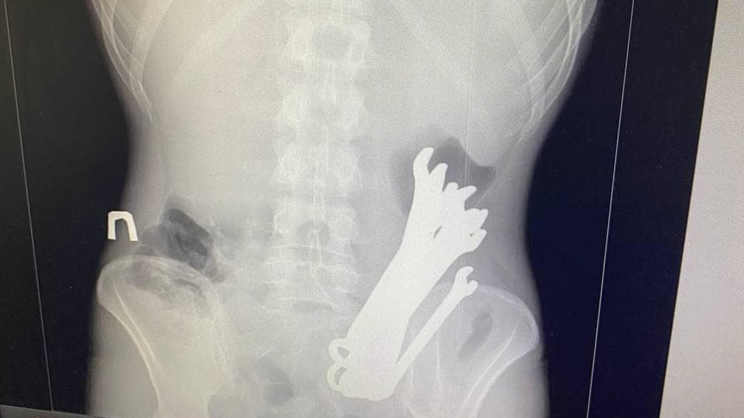 Черкаські лікарі дістали з пацієнта шість гайкових ключів