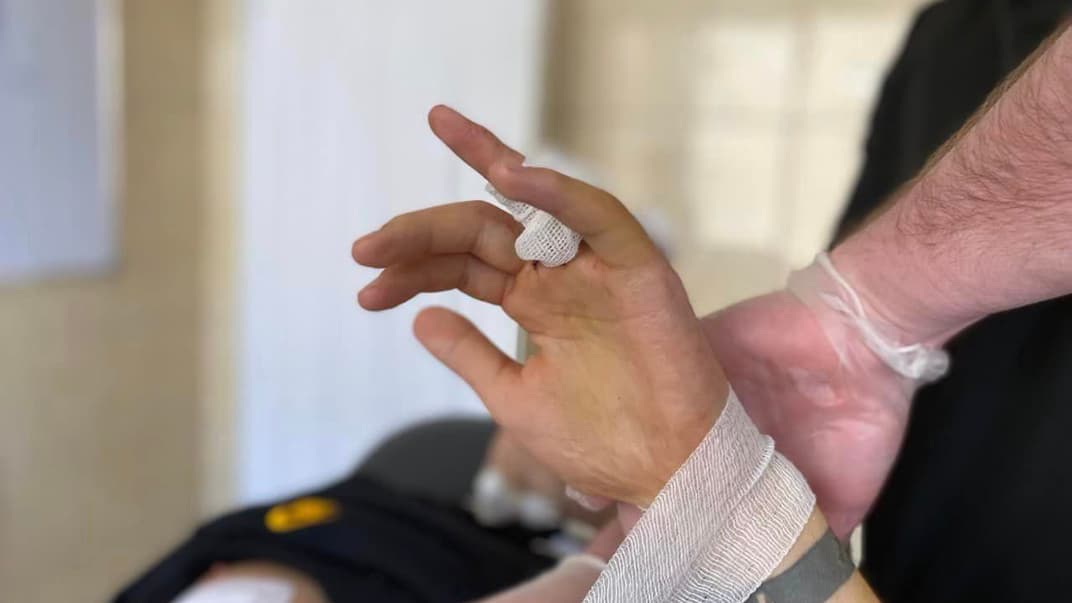 Палец пациента, сформированный из части ребра