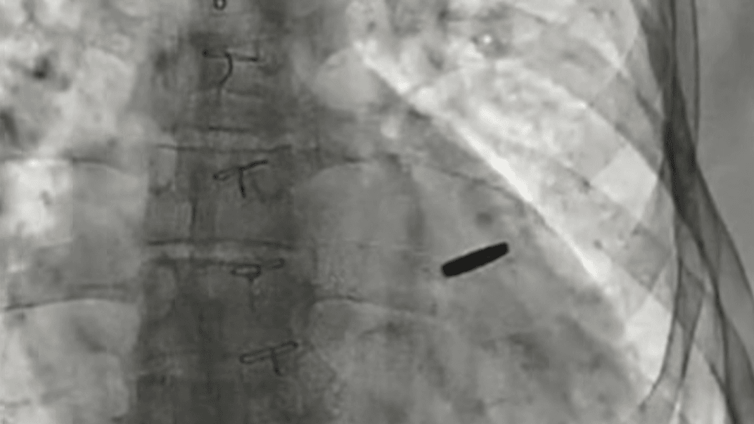 Куля в серці військового