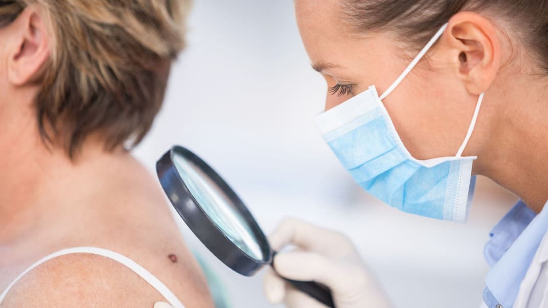 Опасные родинки: как уберечься от меланомы