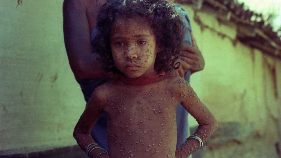 Маленька індійська дитина, захворіла на віспу в селі Хакегора в Індії, 23 червня 1974 року.