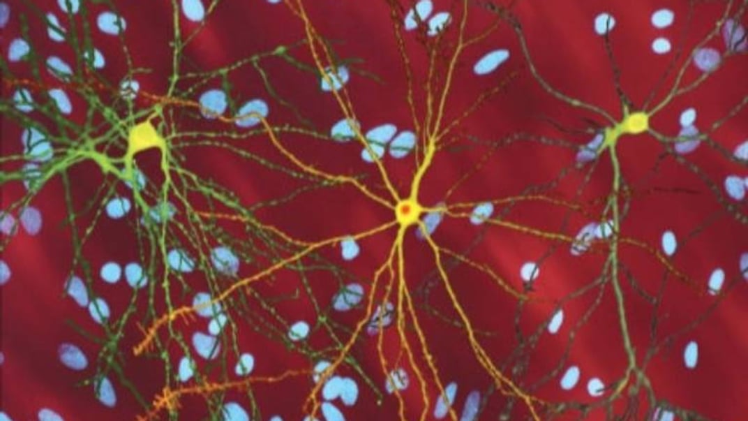 Смугасті тіла, трансфікованих версією гена, пов'язаного з хворобою, — білком, що викликає хворобу Гантінгтона