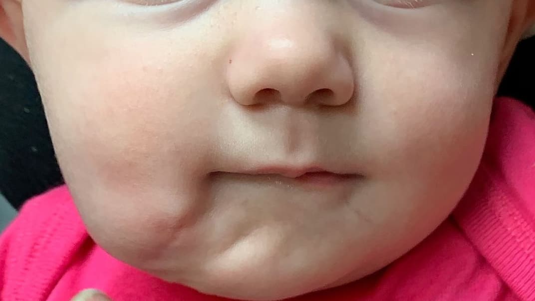 Ця дівчинка народилася з двома ротами. Її успішно прооперували через пів року після народження