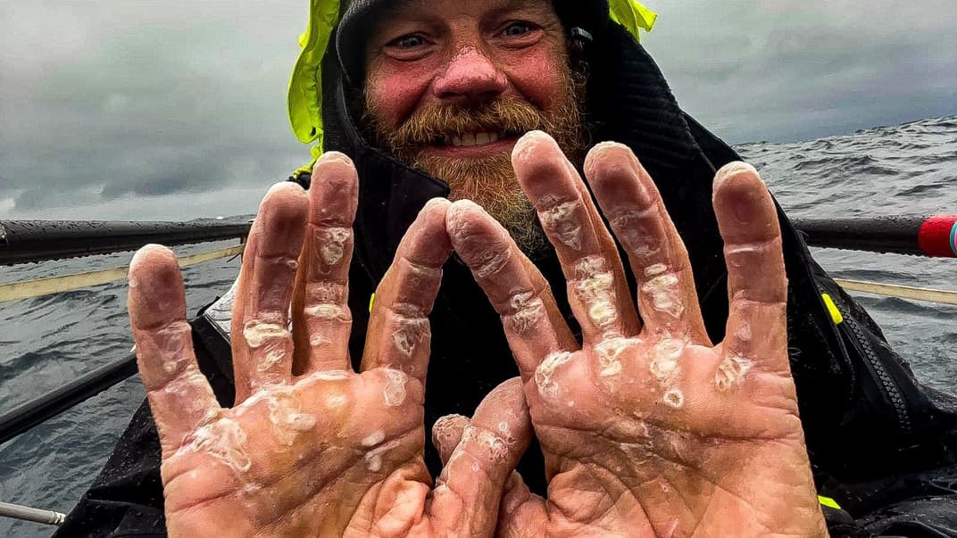 Дэйв Белл показывает свои руки после более трех месяцев одинокого плавания в Атлантическом океане. Фото 10 сентября 2021 года