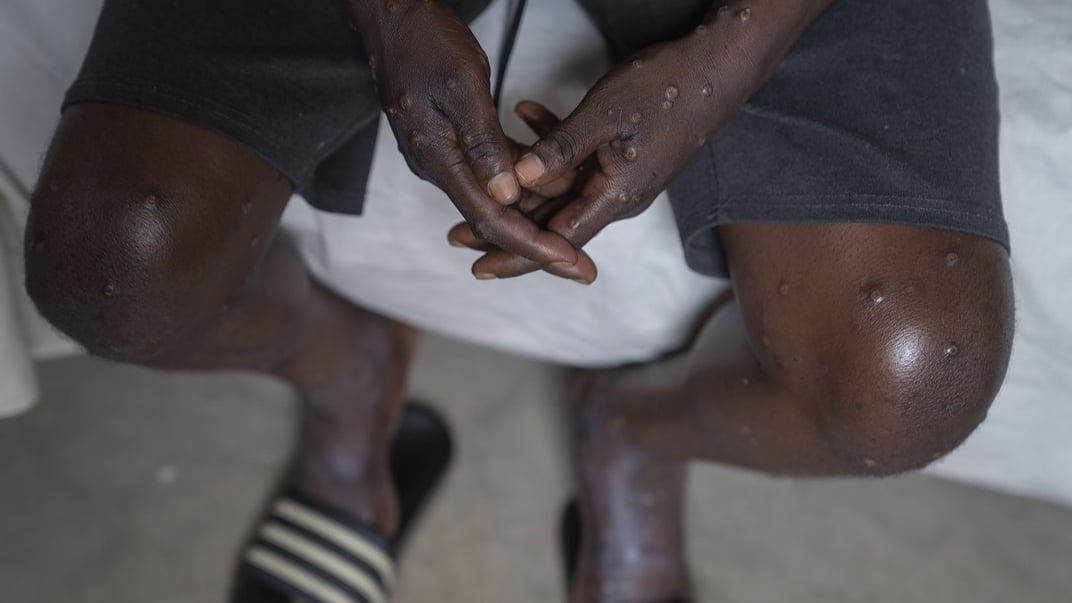 Иллюстративная фотография. Мужчина, зараженный обезьяньей оспой (mpox), лечится в больнице в Демократической Республике Конго, 16 июля 2024 года