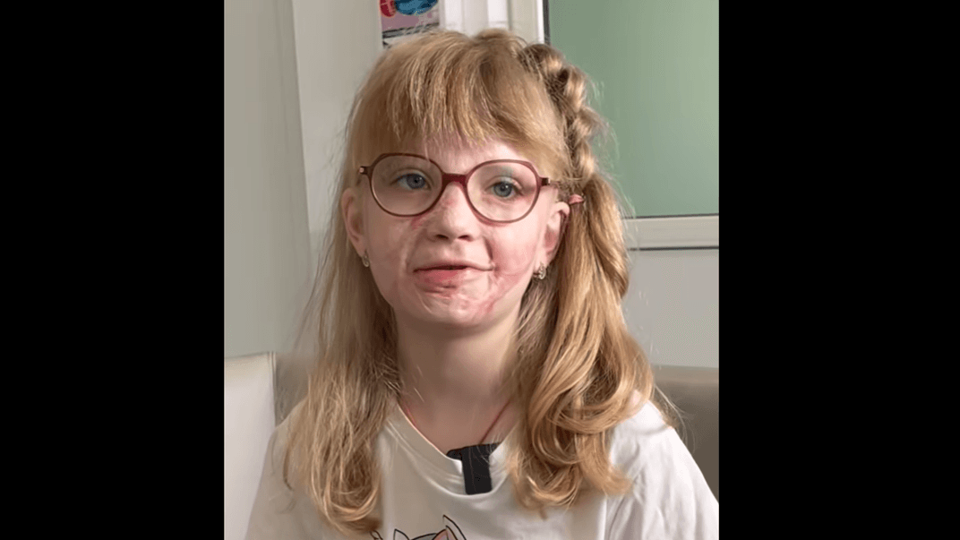 7-річна Аня, що постраждала внаслідок авіатрощі у Броварах