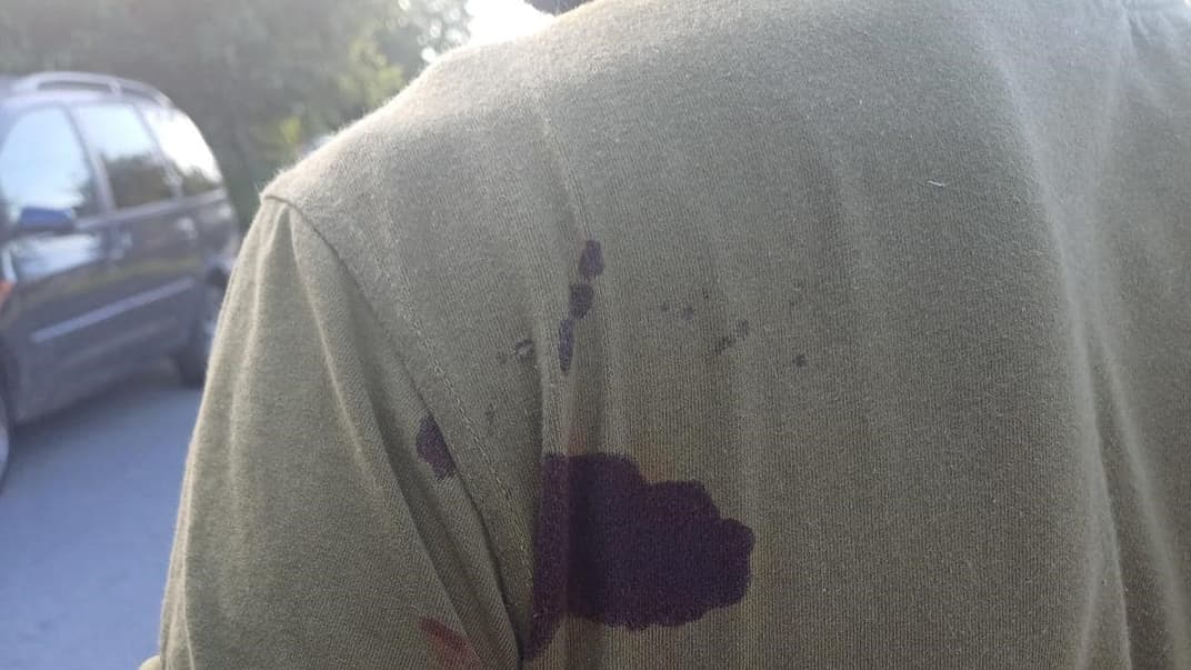 Следы от ранения в результате нападения на работника ТЦК в Хмельницкой области