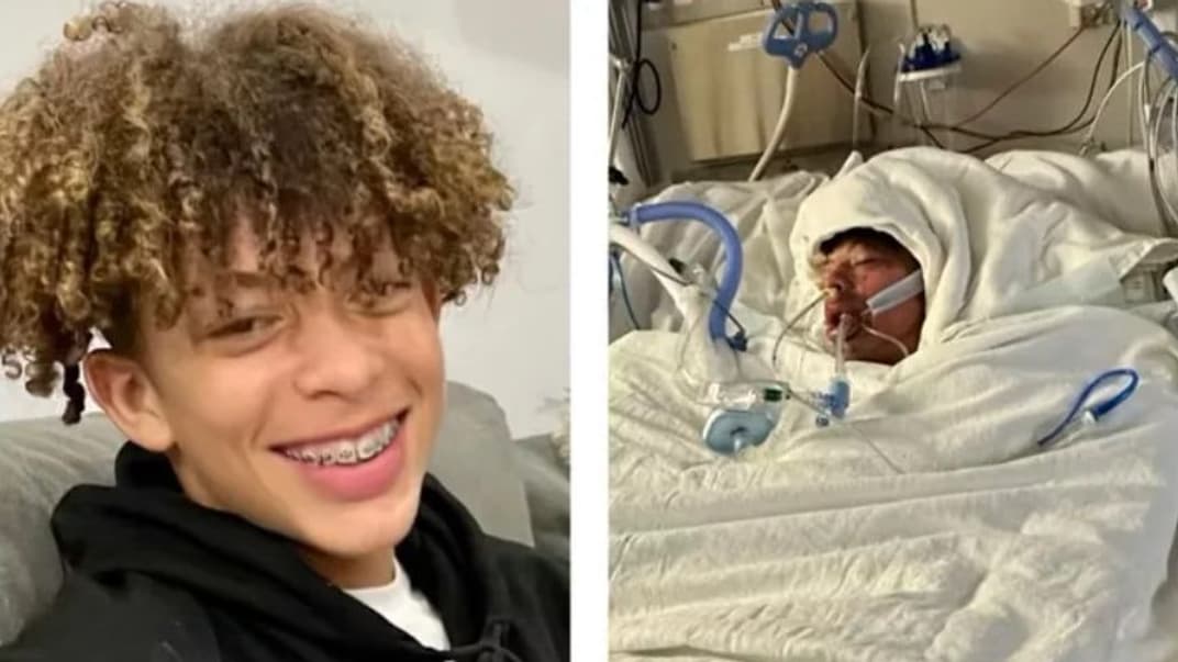 16-летний подросток до и после получения ожогов