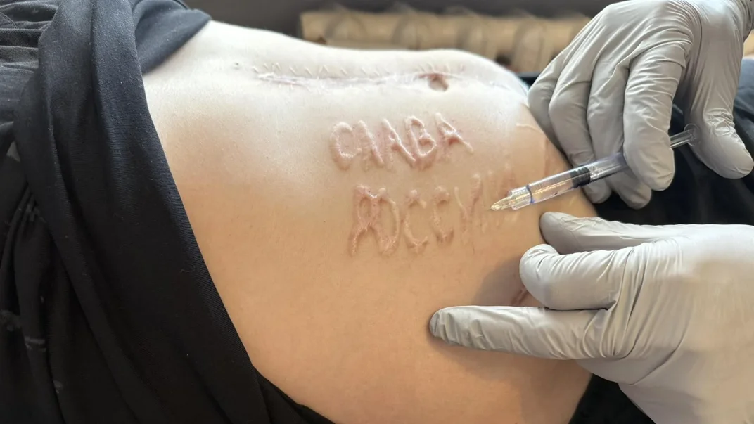 Напис «Слава росії» на тілі українського військового Андрія Переверзєва