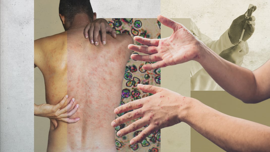 Епідемія вже близько? Все, що варто знати про кір