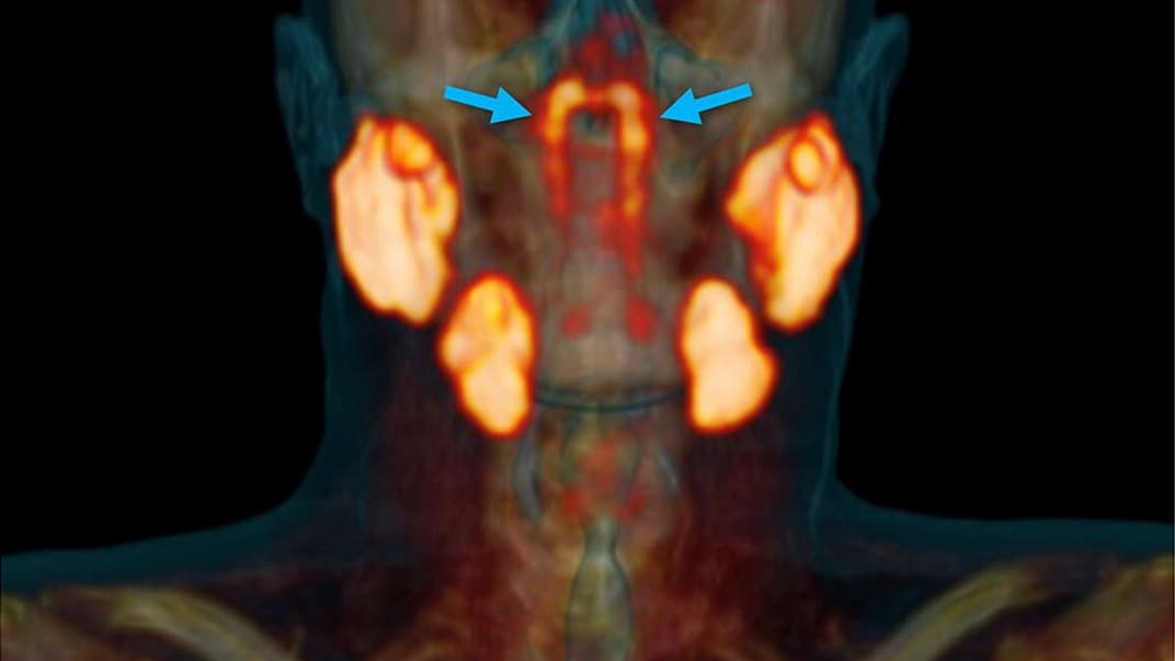 В центре нашей головы открыли неизвестный до сих пор орган. Как это поможет в лечении людей с раком?