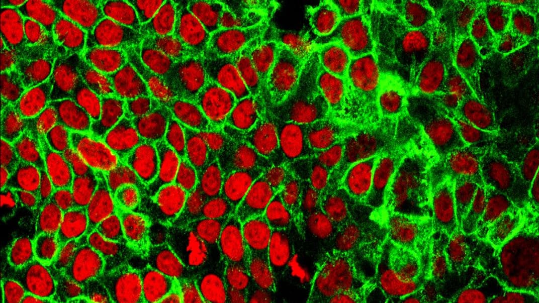 Клетки рака толстой кишки человека с ядрами, окрашенными красным цветом