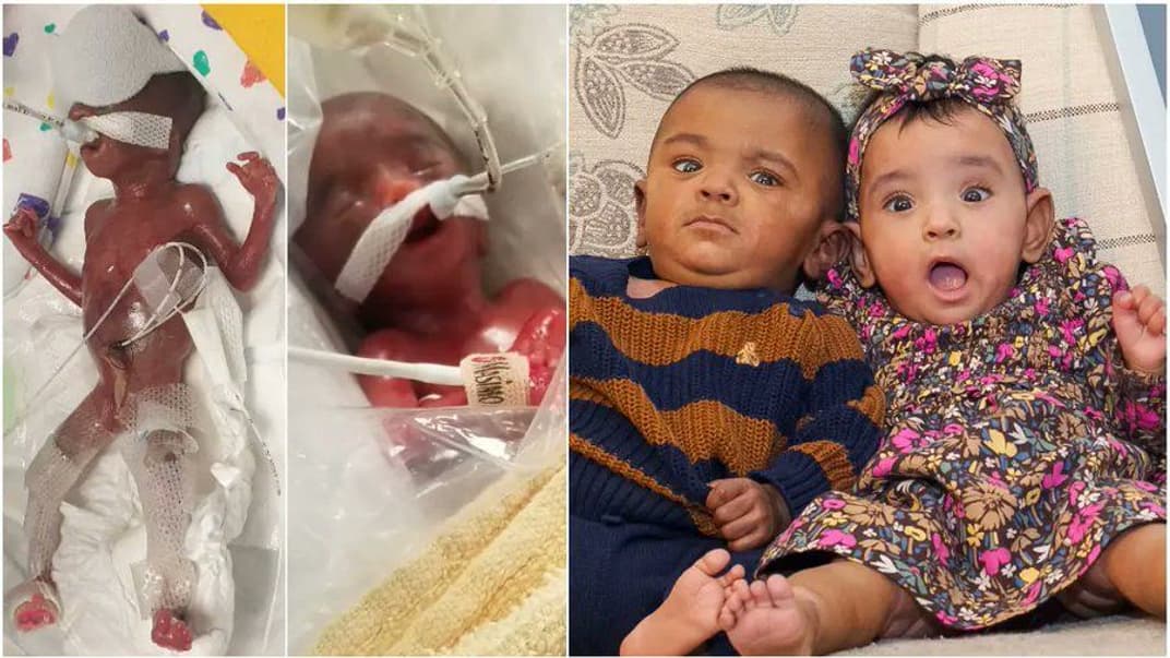 Самые недоношенные близнецы в мире сразу после рождения и год спуст