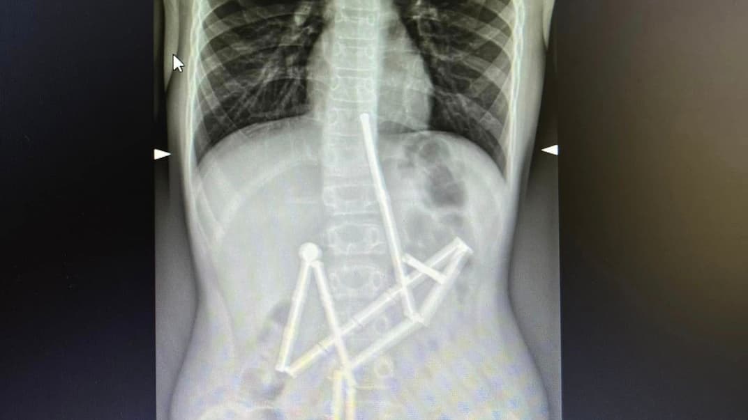 Лікарі «Охматдиту» врятували дитину, яка проковтнула 20 магнітів
