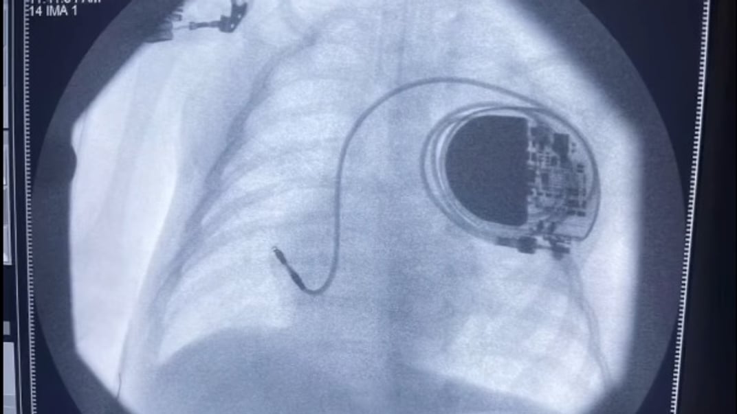 Одеські медики вживили електрод у серце немовляти