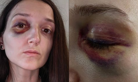 Вікторія Воловенко, яку 8 листопада побили у львівському трамваї