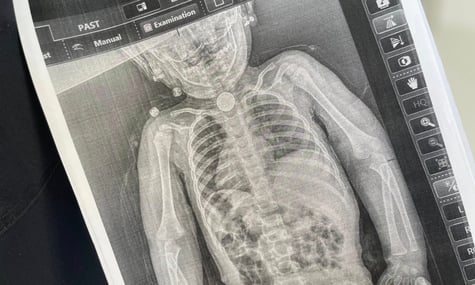 У Львові хірурги врятували дворічну дівчинку, яка три місяці жила з батарейкою у стравоході