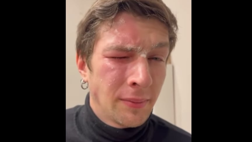 Андрій Кулько після атаки газовим балончиком