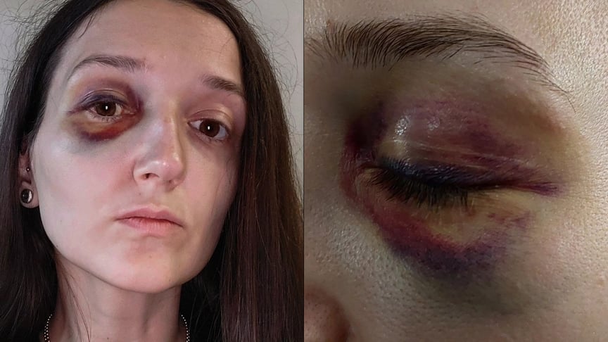 Колаж. Вікторія Воловенко, яку 8 листопада побили у львівському трамваї