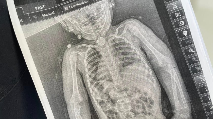 У Львові хірурги врятували дворічну дівчинку, яка три місяці жила з батарейкою у стравоході