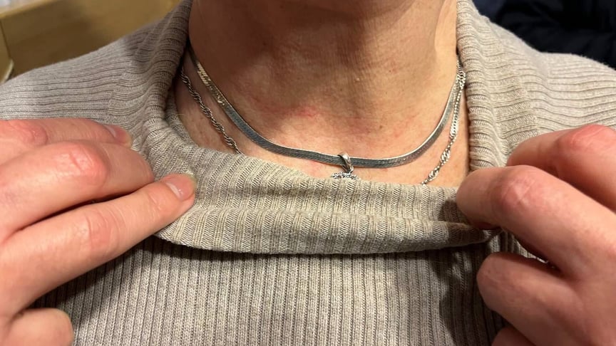 Сліди на шиї матері військовополоненого, яку душили та пограбували в Києві, 25 жовтня 2022 року