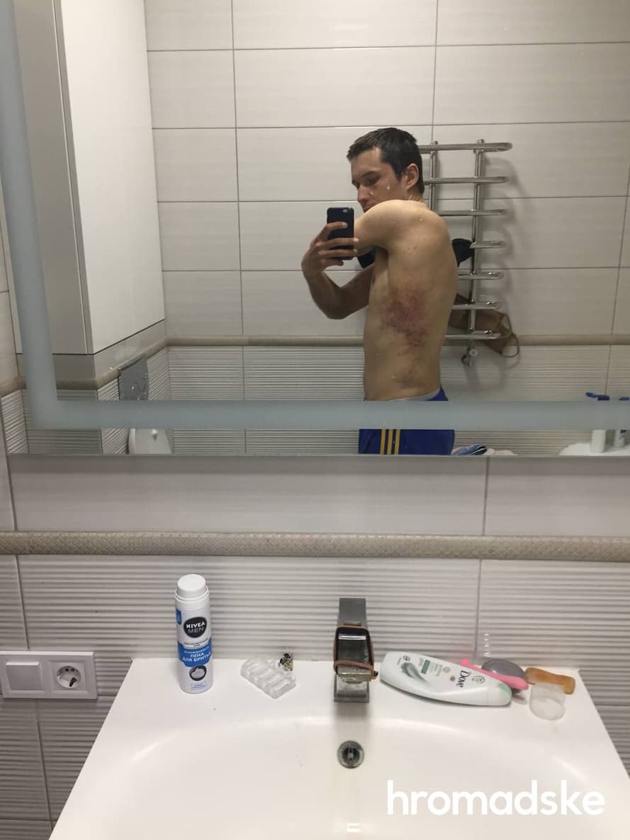Сліди від побоїв після трьохденного перебування Олексія Семікова в полоні російських окупантів
