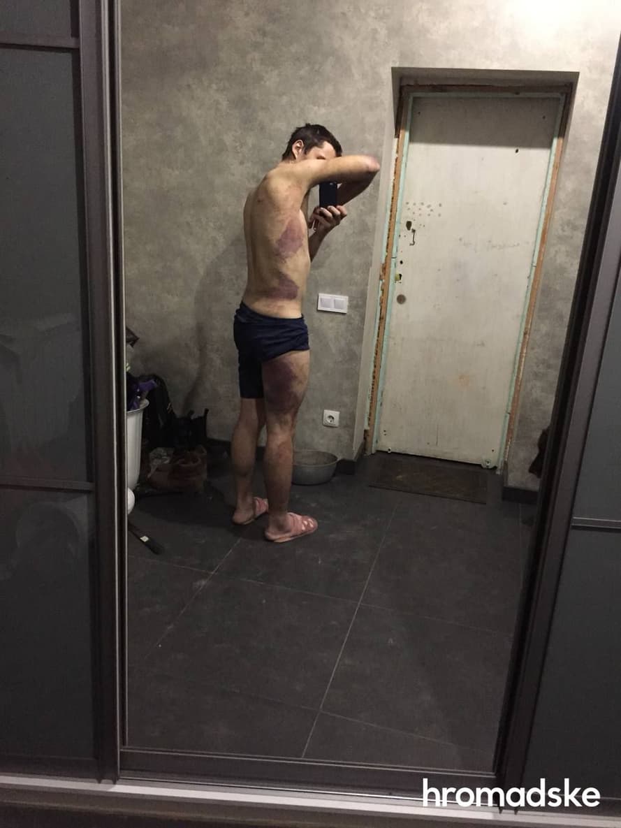 Сліди від побоїв після трьохденного перебування Олексія Семікова в полоні російських окупантів